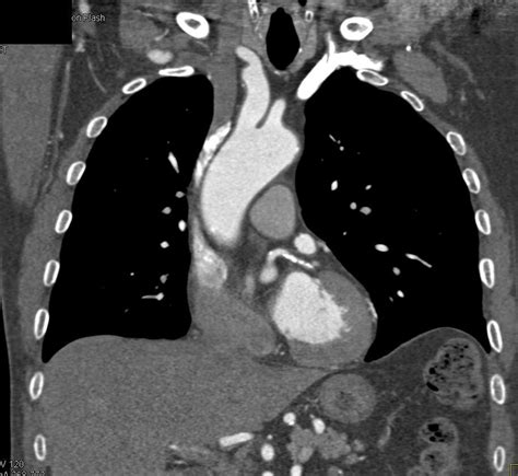 Aortic Valve Calcification And Coronary Artery Calcification Chest