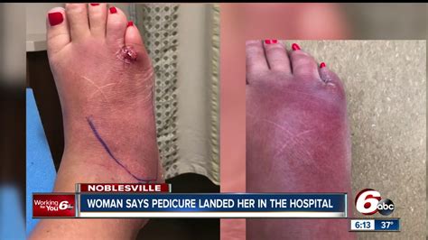 Woman Claims She Got A Serious Foot Infection After Pedicure At A