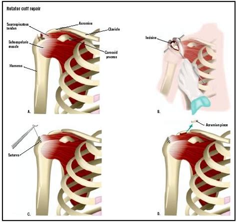 During an arthroscopic repair of a rotator cuff tendon, the surgeon inserts a tiny camera and tools through small incisions in the shoulder. Rotator cuff repair . Causes, symptoms, treatment Rotator ...