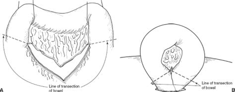 Loop Colostomy And Colostomy Closure Basicmedical Key