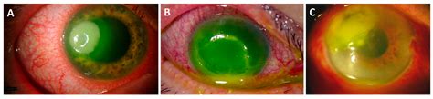 Pseudomonas Aeruginosa Eye Infection