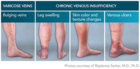 Medical Poster Chronic Venous Insufficiency On Behance