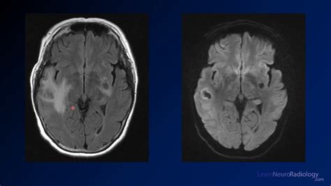 Imaging Brain Tumors 5 Non Glial Tumors Youtube