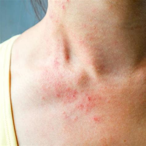 Different Skin Rashes That Itch