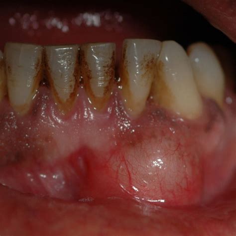 Swelling In The Left Lateral And Canine Segment Of Mandible Figure