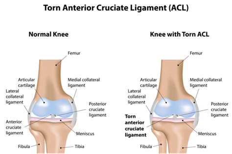 It is 1 of 4 ligaments in your knee. ACL Tear | Knee Specialist | Austin, Round Rock, Cedar Park TX