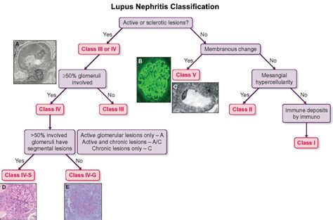 Lupus Nephritis Classification Algorithm Lupus Grepmed