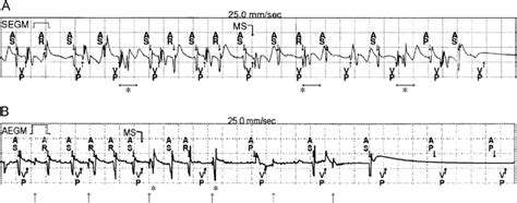 Stored Intracardiac Electrograms Egms Of Type 1 Patient With Complete Download Scientific