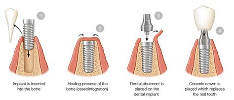 How Does A Dental Implant Work Nyc Dental Implants Center
