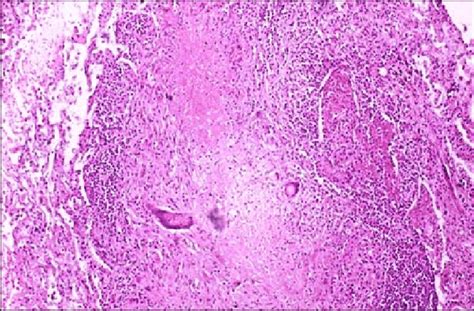 Photomicrograph Showing Epithelioid Granuloma With Central Area Of