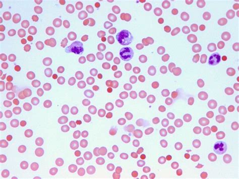 Haemolytic Anaemia In A Case Of Clostridium Perfringens Septicaemia
