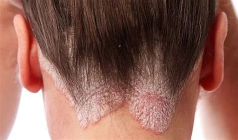 Seboreik Dermatit Nedir Nedenleri Belirtileri Ve Tedavisi Anadolu Hot
