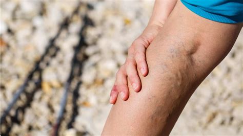 Leg Pain Upper And Lower Leg Pain Maryland Vascular Specialists