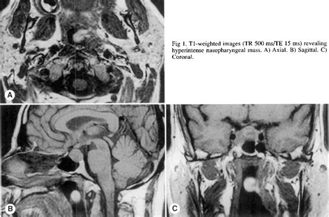 Figure I From Magnetic Resonance Features Of Nasopharyngeal Teratoma