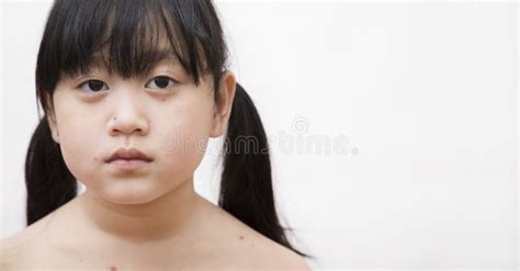chiusura di una varicella nuda malattia di una bambina malata di varicella su sfondo bianco