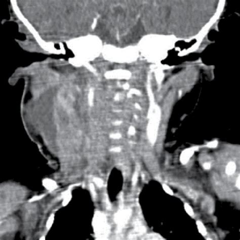 Contrast Enhanced Computed Tomography Scan Of The Head And Neck