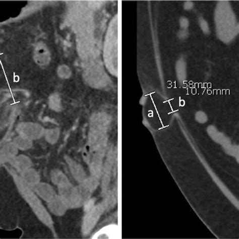 Hernia Sac A And Neck B Measurements On CT Scan For An Incisional Download Scientific