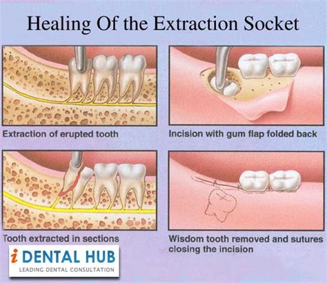The Healing Process Of The Extraction Socket Starts Immediately After