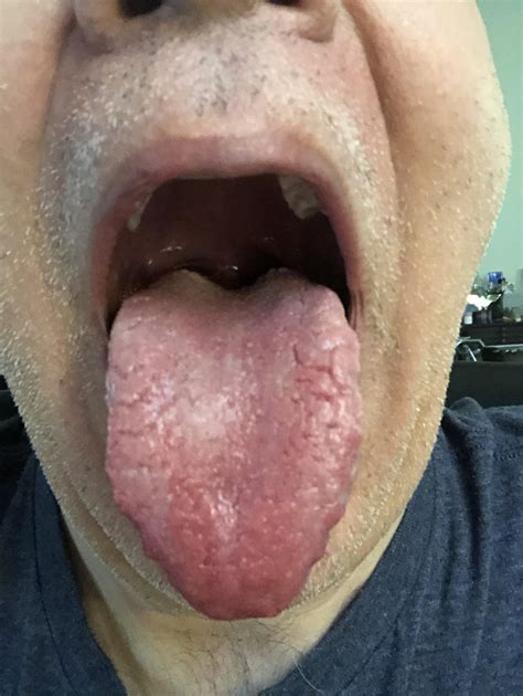Help My Tongue Started Turning White Im Working On Brushing More To
