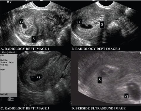Subchorionic Hemorrhage Appearing As Twin Gestation On Endovaginal