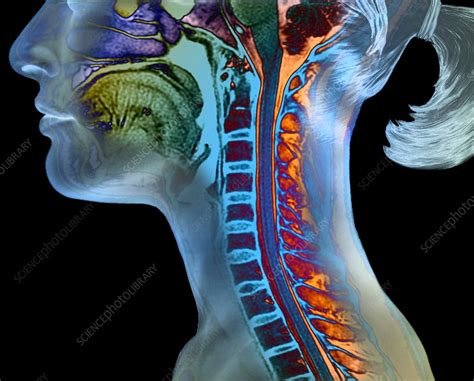 Cervical Spine And Brainstem Mri Scan Stock Image C0371657