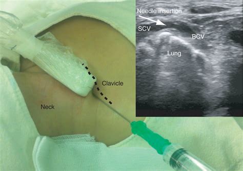 Comparison Between Ultrasound Guided Supraclavicular And
