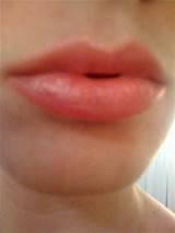 Images of Allergic Reaction Swollen Tongue Treatment