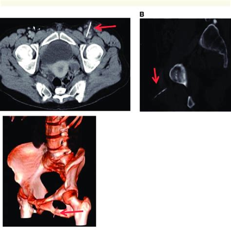 A Pelvic Computed Tomography Scan Cross Section B Pelvic Computed