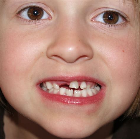 Filedeciduous Teeth By David Shankbone Wikipedia