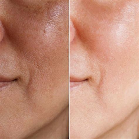 Laser Pigmentation Removal Heswall Laser Clinic