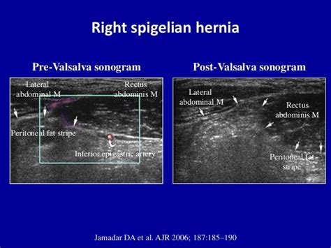 Abdominal Wall Ultrasound Showing Spigelian Hernia Abdominal Hernia