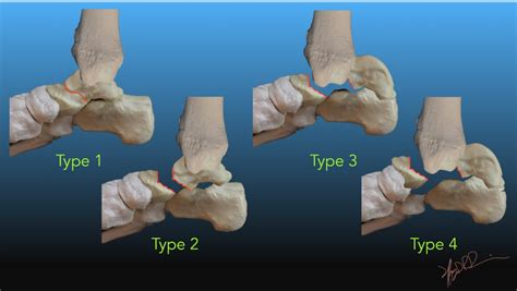 Hawkins Classification Of Talar Fractures Uw Emergency Radiology