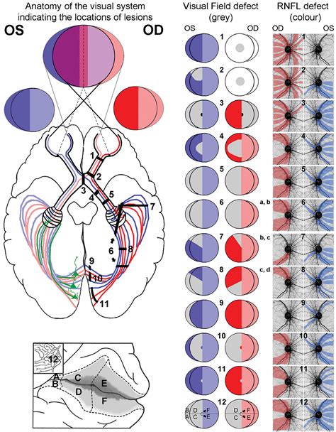 Neurological Visual Field Defect