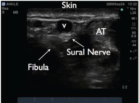 Ultrasound Image Of The Sural Nerve In The Ankle The L Open I