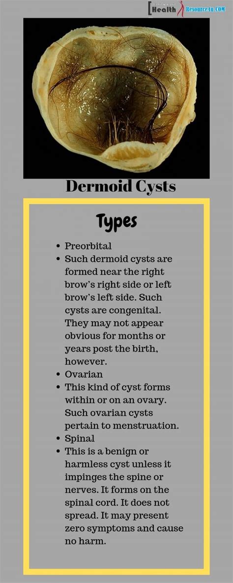 Dermoid Cyst Causes Pictures Symptoms And Treatment