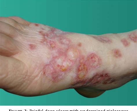 Figure 2 From Synchronous Pyoderma Gangrenosum And Inflammatory Bowel