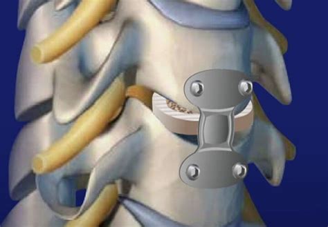 Spine Surgeries Orthoindy Orthopedic Care At Orthoindy