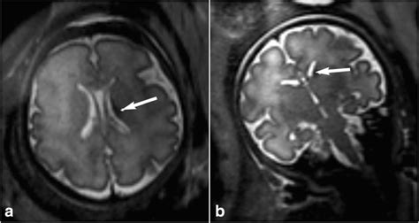 Grade 1 Germinal Matrix Haemorrhage In A 33⁺¹ Weeks Gestational Age