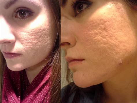 Updated Dermarolling Great Results Pictures Scar Treatments By