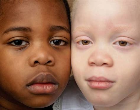 These Twins Have Different Skin Colors 15 Pics