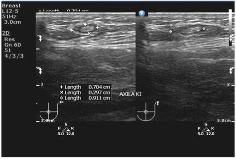 Ultrasound Examination Of Gynecomastia Case In Male Patient Case Report