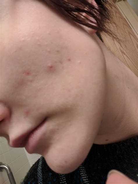 Acne Are These Bumps On My Face Closed Comedones I Cant Seem To Get