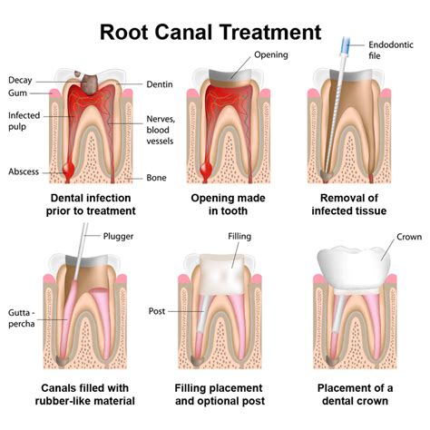 Gregory S Strain Dds Root Canal Therapy In Harvey