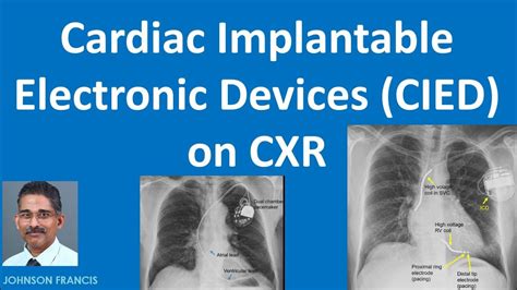Cardiac Implantable Electronic Devices Cied On Cxr Youtube