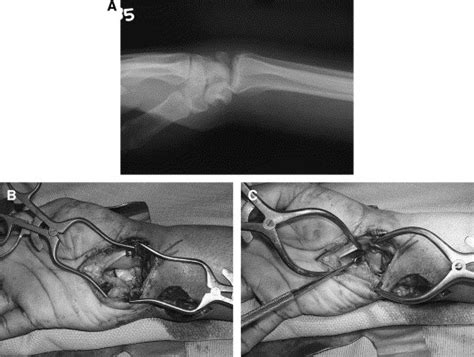 Surgical Approaches To The Carpus Hand Clinics