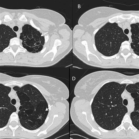 Chest Ct Scan Areas Of Unilateral Emphysema And Cystic Bronchiectasis