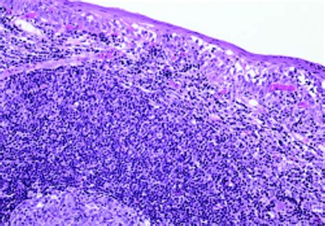 A Case Of Primary Low Grade Mucosa Associated Lymphoid Tissue Malt