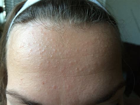 Itchy Bumps On Forehead Pictures Photos