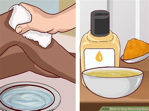 3 Ways To Stop Recurring Boils Wikihow