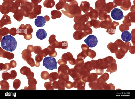 Acute Monocytic Leukaemia Light Micrograph Of A Blood Smear From A